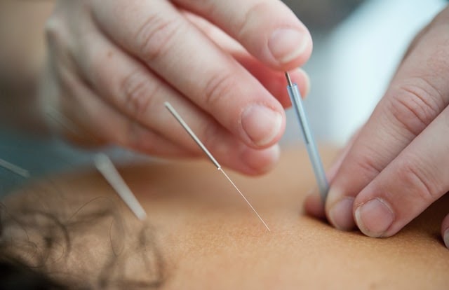 A person receiving acupuncture treatment on their back